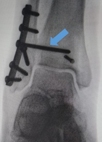 Radiografia do tornozelo com seta indicando parafuso transindesmal.