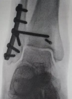 Radiografia do tornozelo com seta indicando parafuso transindesmal