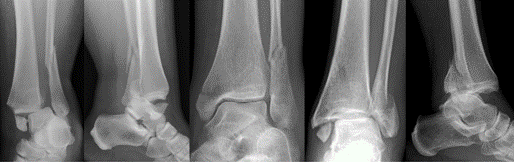 Radiografias do tornozelo, mostrando diferentes tipos de fratura.