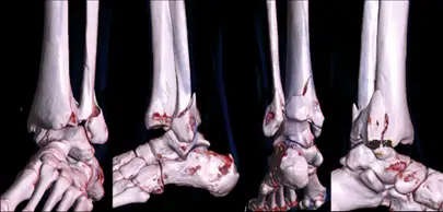 Reconstrução 3D na tomografia computadorizada mostrando fratura do tornozelo acometendo os maléolos medial, lateral e posterior.
