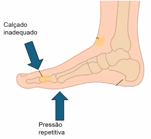 Ilustração mostrando as principais causas dos calos no pé: pressão repetitiva, uso de calçado inadequado e sobrecarga no tendão de Aquiles.