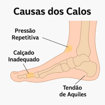 Ilustração mostrando as principais causas dos calos no pé: pressão repetitiva, uso de calçado inadequado e sobrecarga no tendão de Aquiles.