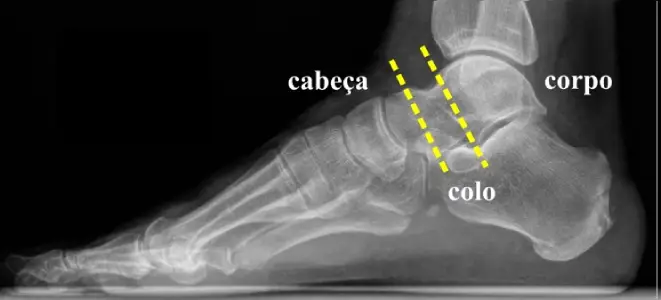 Raio-x com destaque para as partes do tálus: cabeça, colo e corpo.