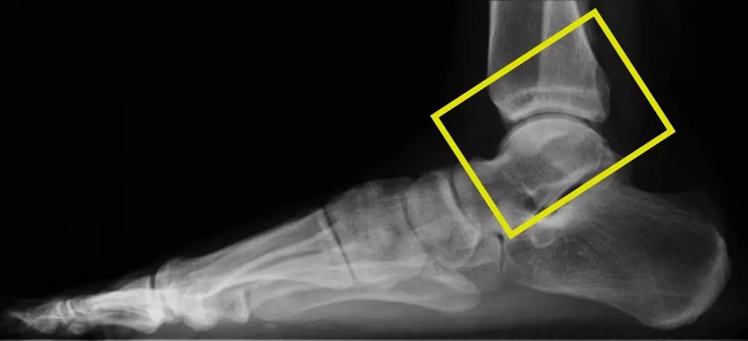 Radiografia em perfil. O quadrado amarelo mostra o tornozelo.