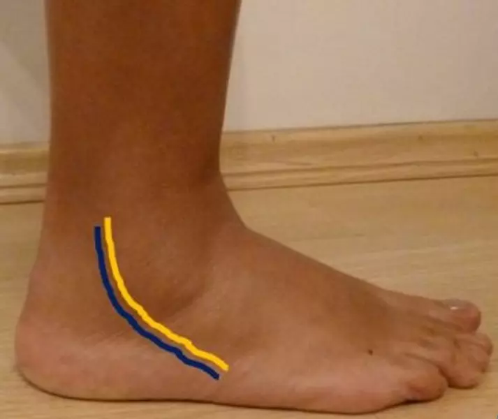 Amarelo: trajeto do tendão fibular curto. Azul: trajeto do tendão fibular longo.