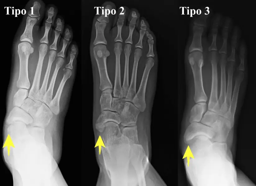 Radiografias dos três tipos de navicular acessório: Tipo 1, Tipo 2 e Tipo 3